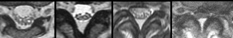 Four axial MRI images of the lumbar spinal canal showing central canal stenosis progressing from normal to severe, with the nerve roots increasingly crowded.