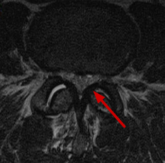 Axial cross-section diagram of a lumbar vertebra showing the central canal, lateral recess, neural foramen, traversing and exiting nerve roots, disc, facet joint, and ligamentum flavum, with one side narrowed by lateral recess stenosis.